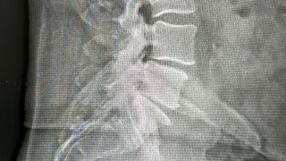 Lumbar Sacralization With Advanced Spondylosis - Louisiana Ring Dinger