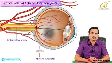 Branch Retinal Artery Occlusion (BRAO) 👁️  Internal Medicine Ophthalmology | USMLE Step 2 CK