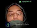 #revisionrhinoplasty by #drsaadatullah #revisionrhinoplastyexpert in #pakistan
