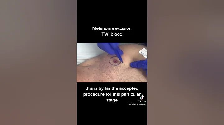 Melanoma excision