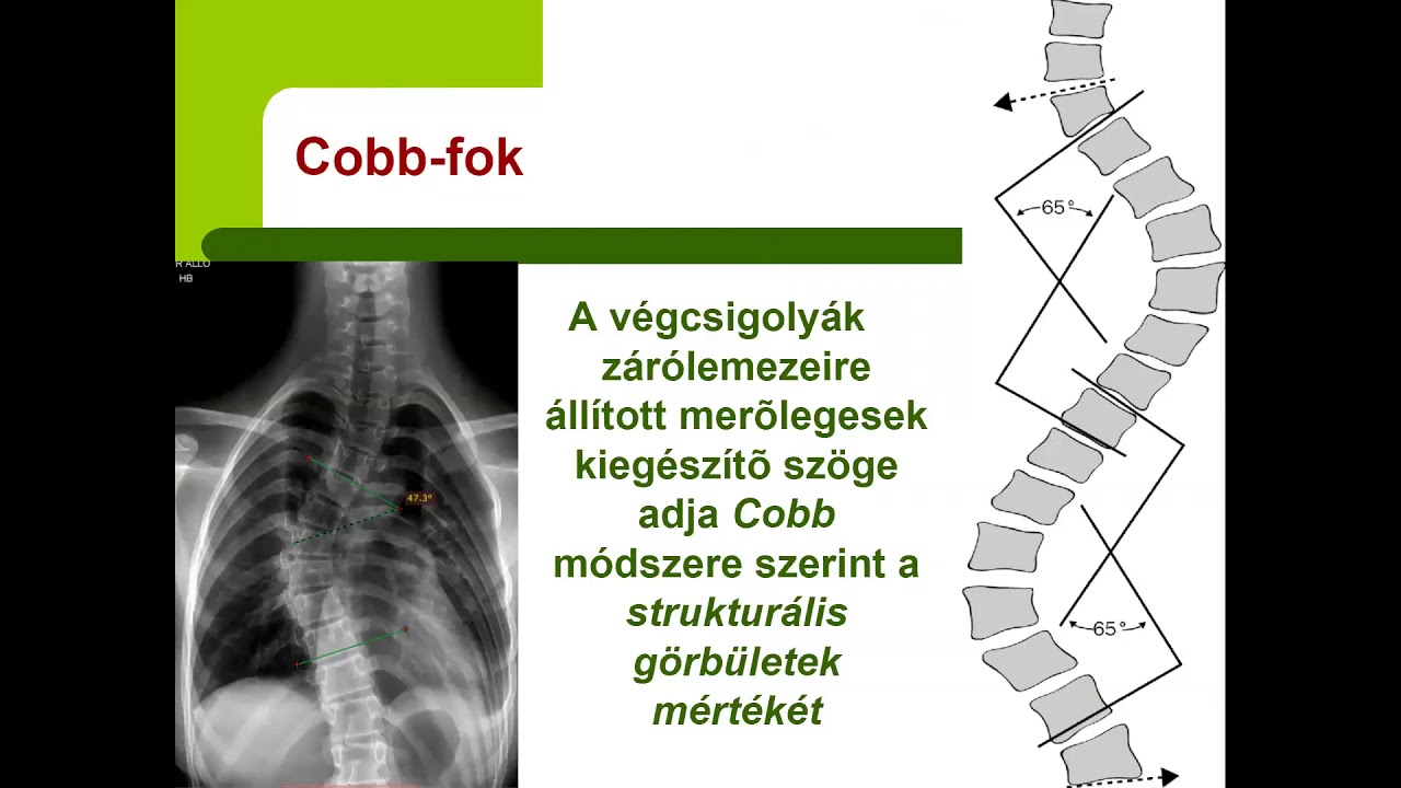 kenőcső könyökfájdalomra)