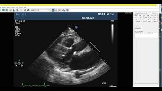 How To Read An Echocardiogram Using Phillips Intellispace Cardiovascular Iscv