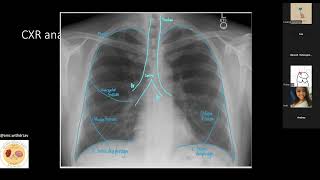 AMC Clinicals - Chest Xray Refresher (Hustle Hub)