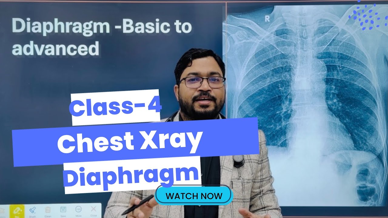 Chest Xray Classes # 4 (Diaphragm Basic to Advanced)