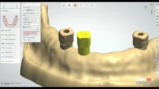 How to Design a PreatLoc™ Abutment in 3Shape®