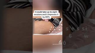 See you later StretchMark #microneedling
