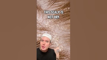 HOW TO GET RID OF DANDRUFF!😱 (follow for more!💗) #dandruff #hair #haircare #hairstyle #haircut