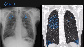 Radiology of cystic lung diseases - learn in 5-minutes