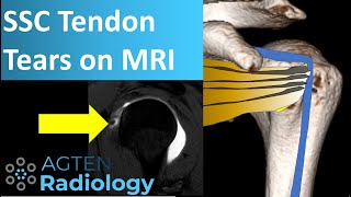 Subscapularis Tendon Tears on MRI