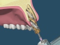 Extração + implante imediato + enxerto