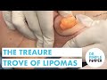 The Treasure Trove of Lipomas