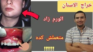 خطأ شائع في علاج خراج الاسنان يجعل الورم يزيد جدا