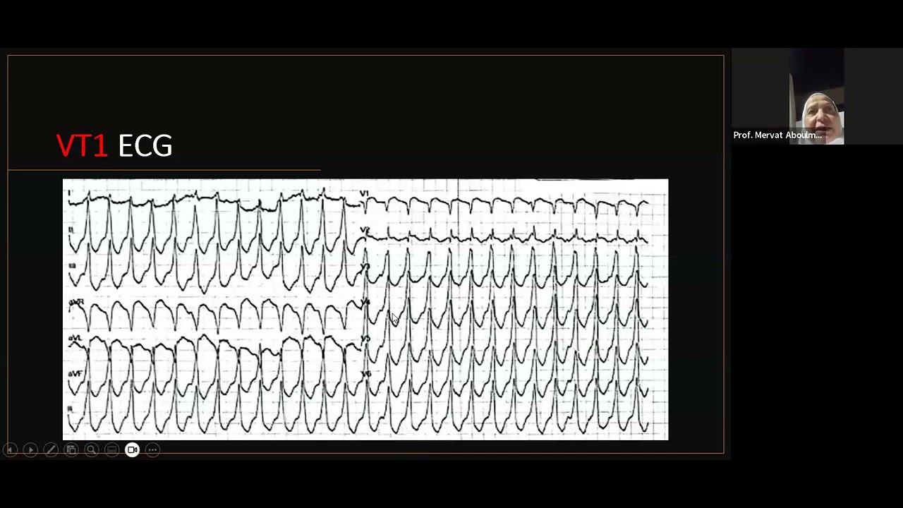 Recurrent VT in Myocarditis;challenges in ablation after initial failure. Hamed Gaber, MBChB