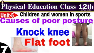Causes of poor posture,postural deformities,knock knee and flat foot,physicaleducation by Vaseem Sir