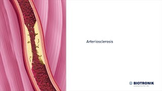 Atherosclerosis and Angiography | Medical Animation