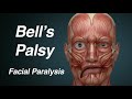 Paralysie de bell paralysie faciale unilatrale