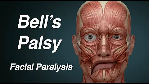 Bell's Palsy (One Sided Facial Paralysis) - DayDayNews