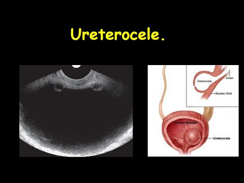 Video: Hoe wordt de diagnose urethrocele gesteld?