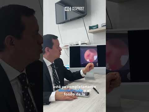 ✅ Resultado exitoso tras una enucleación láser prostática (HOLEP).