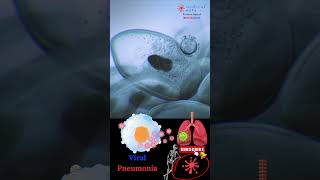 Pneumonia | Respiratory Infection || Viral Pneumonia || Medical Arts #Shorts