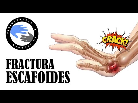 Video: ¿Es el escafoides un hueso del carpo?
