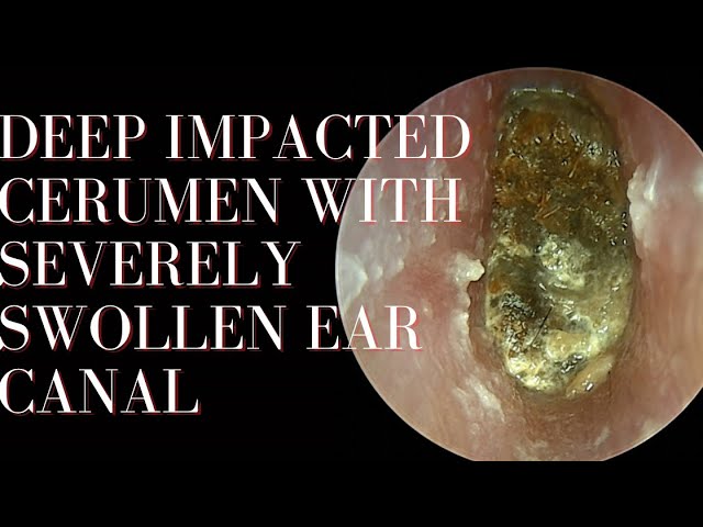 People Will Stop Using COTTON BUD After Watching This Video !!!