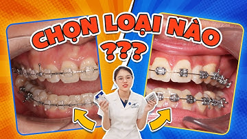 Chọn Niềng Răng Mắc Cài Sứ Hay Kim Loại: 3 Tiêu Chí Giúp Mắc Cài Sứ Ghi Điểm - Lưu Ý Tiêu Chí Thứ 2