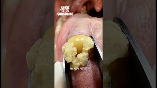 Mun Ki Badboo Ki Asal Wajah! 🤢👄 (Tonsil Stone Removal) #Shorts