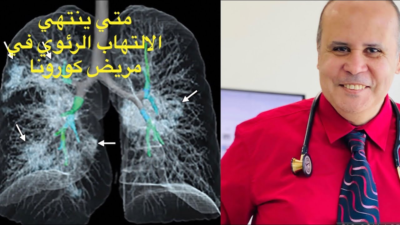 بشري ساره لمرضي كورونا..الرئه ممكن ان تصلح نفسها ويتعافي المريض في فتره بسيطه