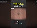 허리디스크 수술은 어떻게 할까? Mp3 Song
