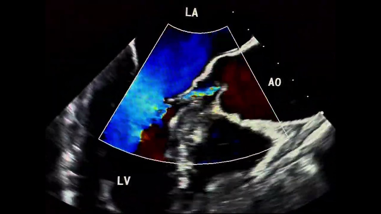Turbulent Flow in the LVOT: Is It Valvular or Subvalvular Pathology?