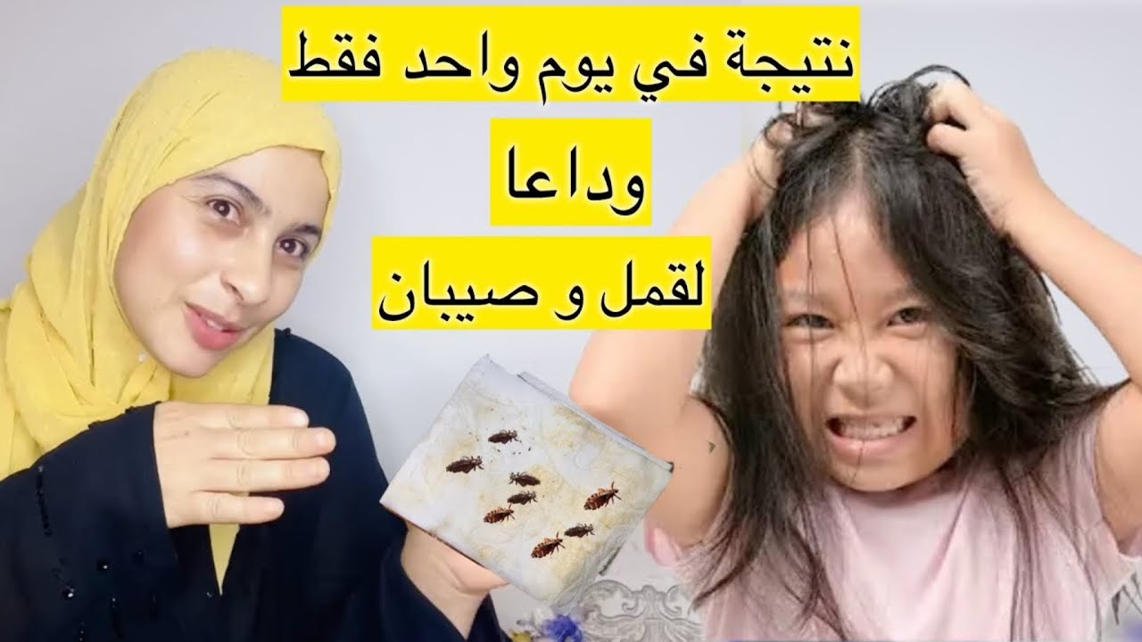 علاج القمل و الصيبان لصغار و كبار في يوم واحد (بتجربة شخصية2024)