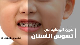طرق الوقاية من تسوس الأسنان للأطفال مع د. سندس التويجري / مجمع سوان التخصصي الطبي