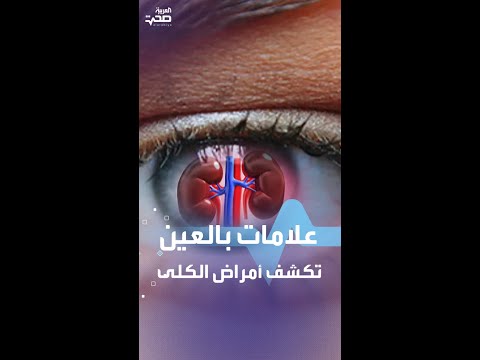 علامات بالعين تكشف أمراض الكلى