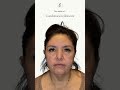 Smooth Skin Transformation | Combination Treatment Results