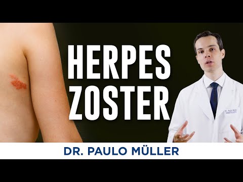 Vídeo: Quem trata herpes zoster?