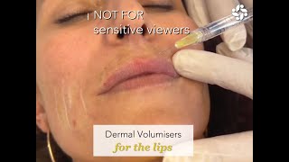 ACHIEVING NATURAL-LOOKING LIP REJUVENATION: TIPS FOR A FULLER YOUTHFUL POUT Prominent Vermilion Border