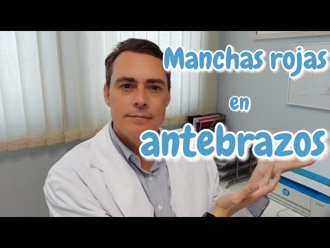 Dermatólogo explica qué es la púrpura de Bateman o púrpura senil