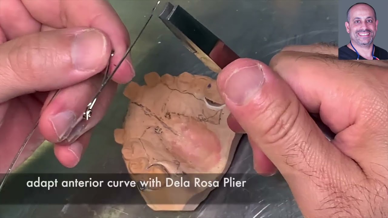 FF024: Quad helix for maxillary expansion step by step orthodontic (braces) (dental) treatment