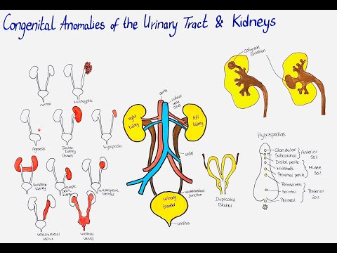 congenital anomalies of
