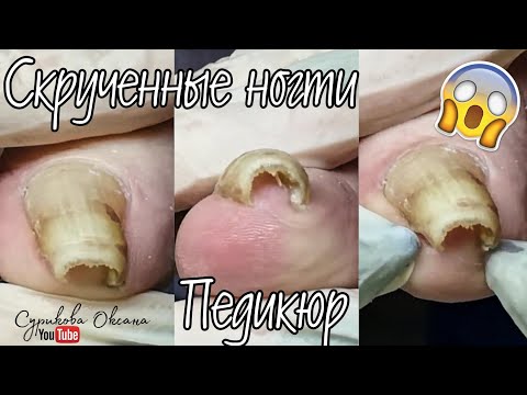 Видео: Толстые ногти на ногах: фотографии, причины и домашние процедуры