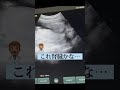 【妊婦検診】エコー検査の結果が心配すぎる… #shorts