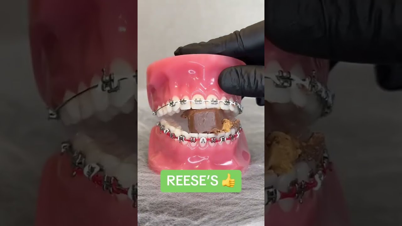 HALLOWEEN CANDY THAT IS SAFE FOR BRACES 