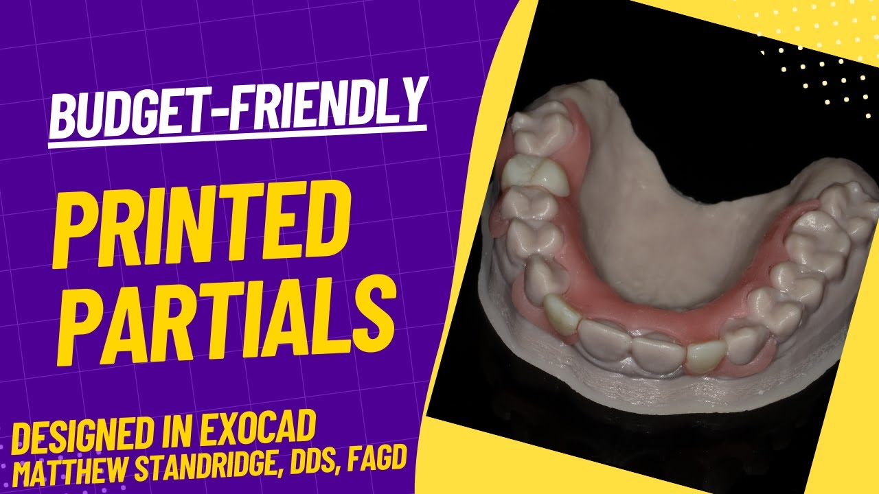 Inexpensive 3D Printed Partials Designed in Exocad