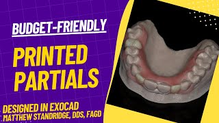 Inexpensive 3D Printed Partials Designed in Exocad