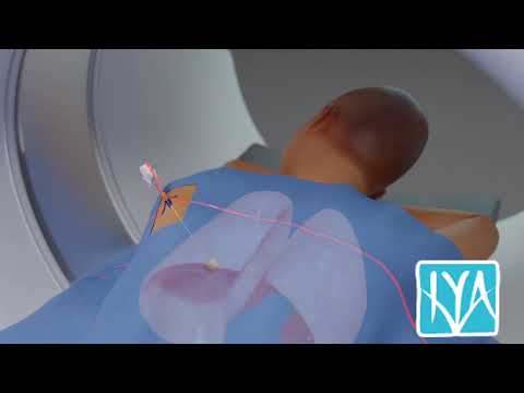 Lung Tumor Biopsy