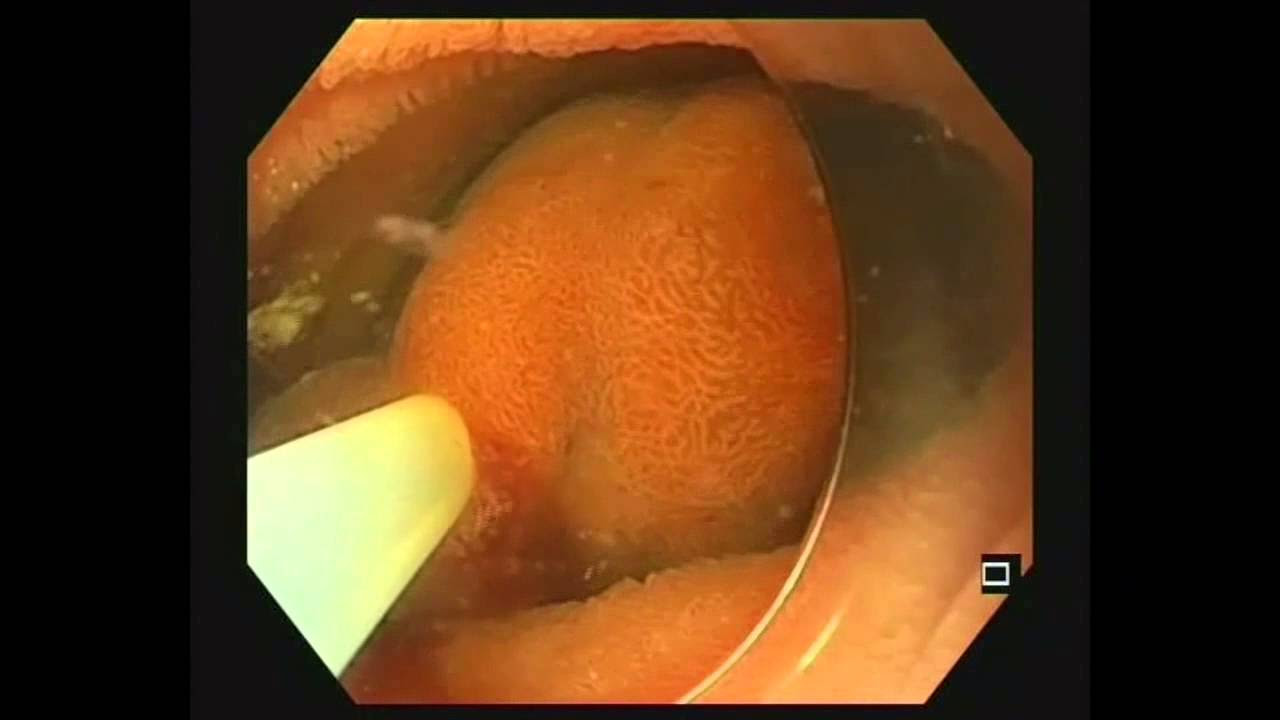 How to prepare and use detachable snares. A video demonstration for nurses and endoscopists.