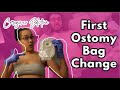 ConvaTec vs. Coloplast - Swapping Ostomy Bag Brands🩺