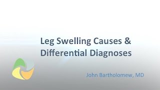 Edema lower icd extremity 10 bilateral
