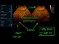Fatty liver (grade 2) || ultrasound